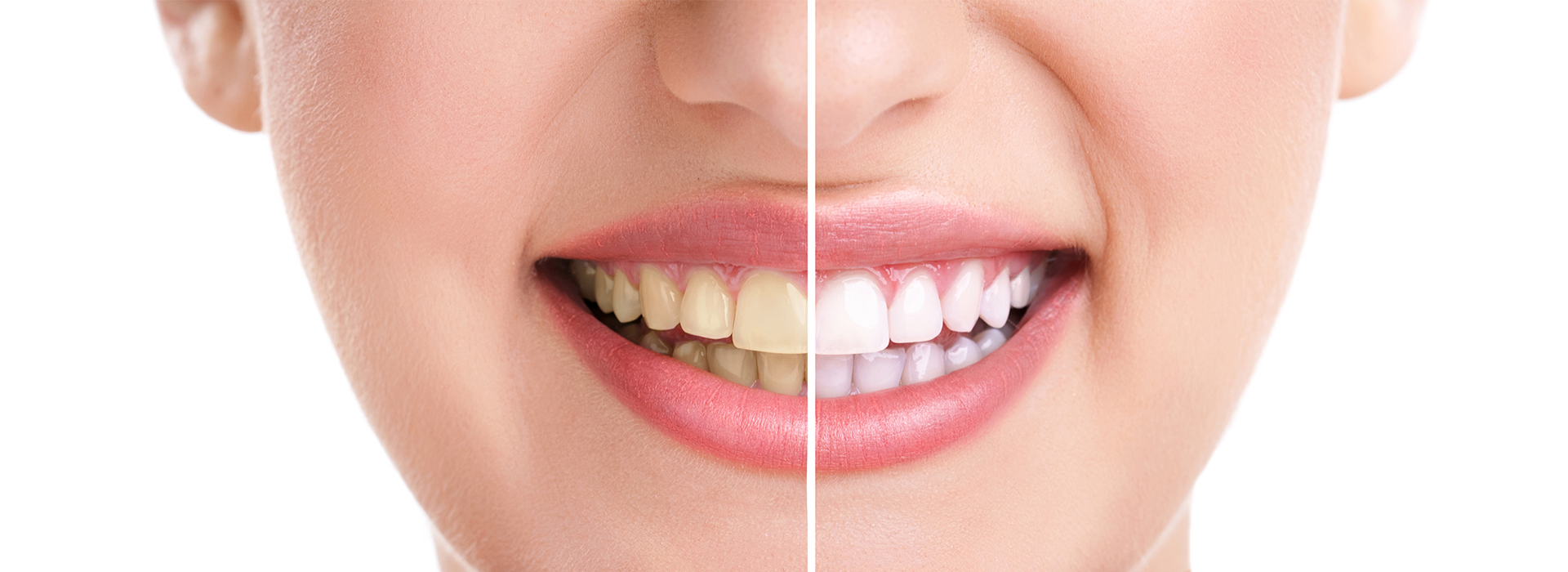 Before and after teeth whitening comparison with a smiling woman.