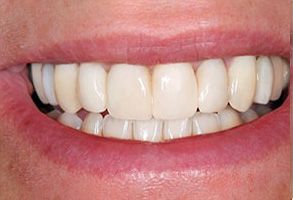 The image shows a close-up of a person s smiling mouth with teeth, and the individual appears to have a clean and well-maintained oral hygiene.