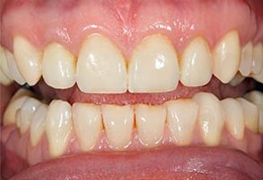 The image displays a close-up of a person s teeth, which appear to be in need of dental care due to discoloration and possible decay.