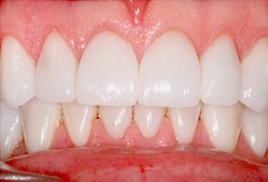 Dental implant with a natural-looking crown, showcasing the result of dental restoration.