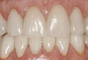 An image of a person s mouth with yellowish teeth and a partial denture, showcasing a dental implant.