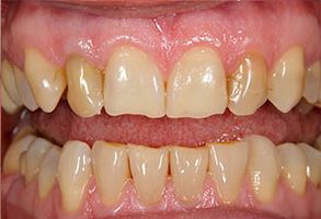 The image displays a close-up view of a person s teeth, showing a set of yellowed teeth with visible staining and discoloration, suggesting poor oral hygiene or dental issues.