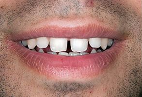Image of a person with an exaggeratedly large smile, showcasing their teeth and lips.