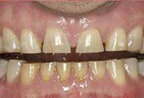 The image shows a close-up of a person s teeth with visible staining and wear, suggesting the need for dental care or treatment.